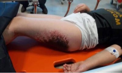 Afyonkarahisar’da Öğrencilerin Vücutlarındaki Yanıkların Sebebi Belli Oldu