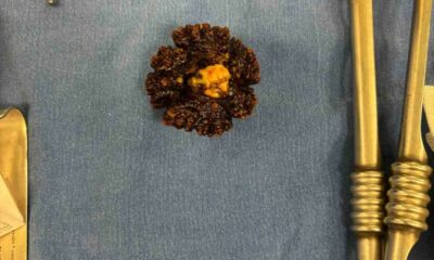 80 yaşındaki hastanın mesanesinden 7 santimetre uzunluğunda taş çıkarıldı