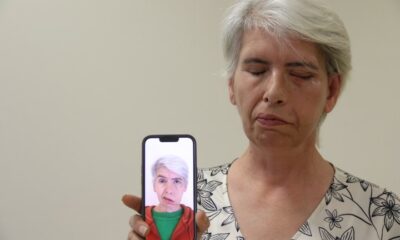 Sol gözünü 41 yıl sonra 24 ayar altınla yapılan tedavi sonucu kapatabildi