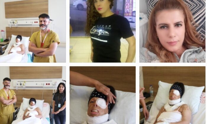 Genç kadının hayatı kezzapla karardı